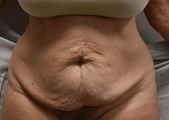 Tummy Tuck (Abdominoplasty): Case 384 - Before