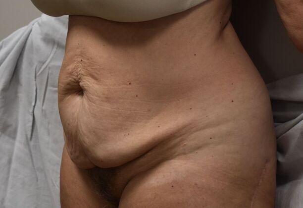 Tummy Tuck (Abdominoplasty): Case 384 - Before