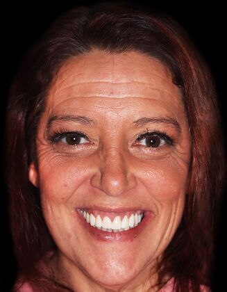 Full Mouth Restoration Marnie-E-max crowns - After