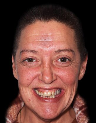 Full Mouth Restoration Marnie-E-max crowns - Before