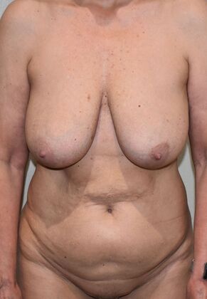 Mommy Makeover Case 248 - Before