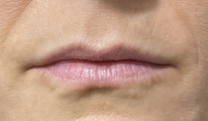 Filler - Lips Case 1 - Before