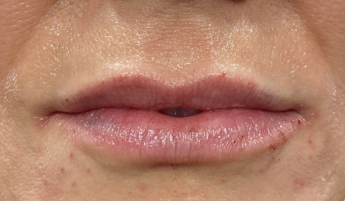 Filler - Lips Case 1 - After