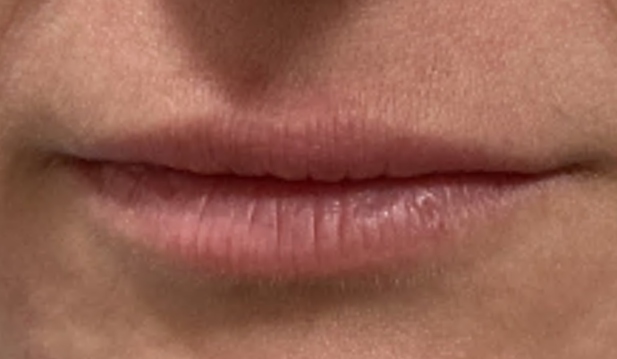 Filler - Lips Case 2 - Before