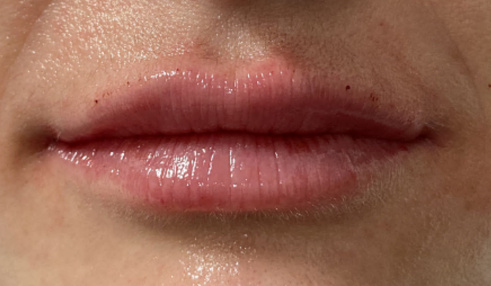 Filler - Lips Case 2 - After