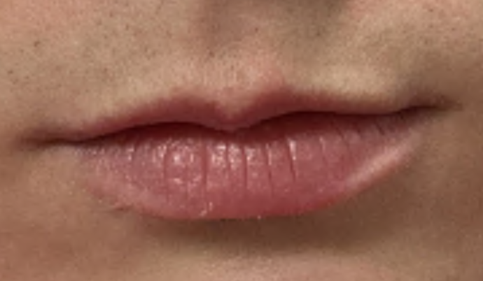 Filler - Lips Case 3 - Before