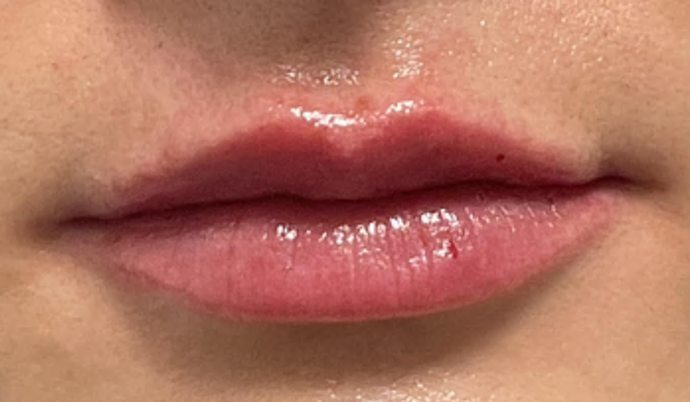 Filler - Lips Case 3 - After