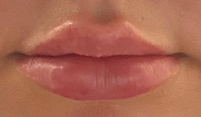 Filler - Lips Case 4 - After
