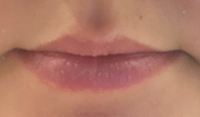 Filler - Lips Case 4 - Before