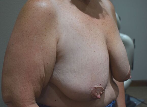 Breast Lift (Mastopexy): Case 153 - Before