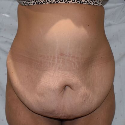 Massive Weight Loss : Case 113 - Before