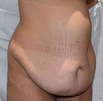Tummy Tuck (Abdominoplasty): Case 386 - Before