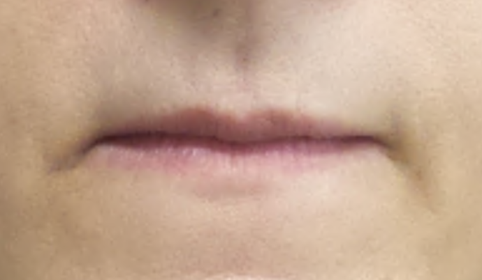 Filler - Lips Case 5 - Before