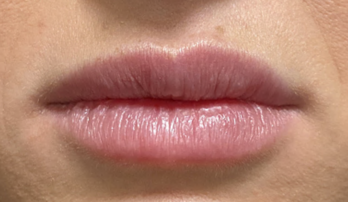 Filler - Lips: Case 6 - Before