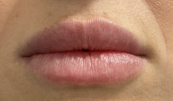 Filler - Lips: Case 6 - After