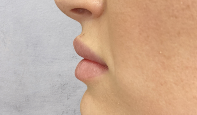Filler - Lips Case 6 - After