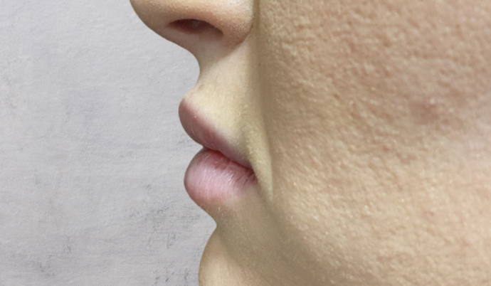 Filler - Lips Case 6 - Before