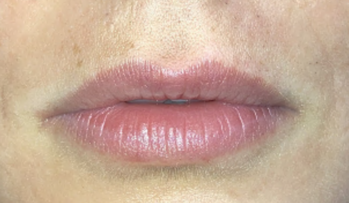 Filler - Lips Case 7 - Before