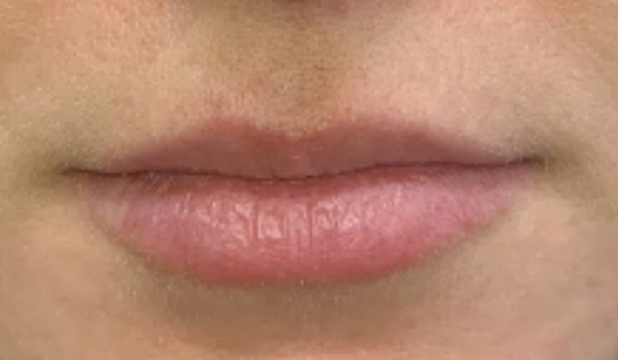 Filler - Lips Case 8 - Before