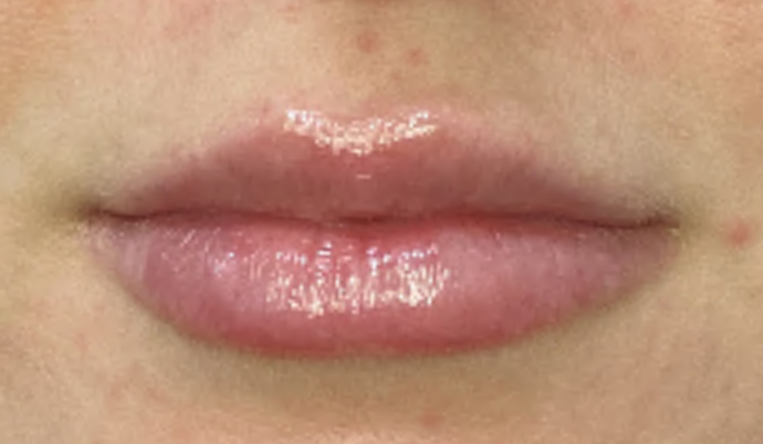 Filler - Lips Case 8 - After