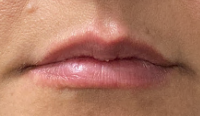 Filler - Lips Case 9 - Before