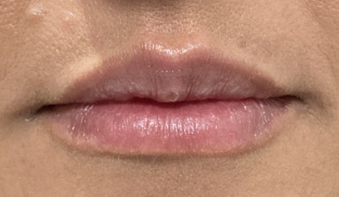 Filler - Lips Case 9 - After