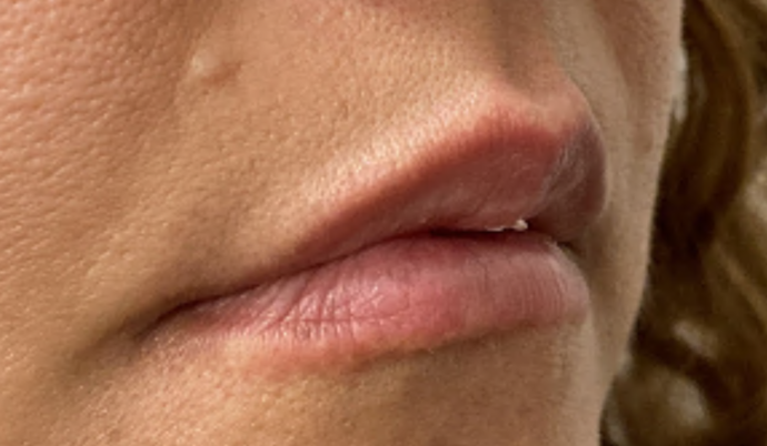 Filler - Lips: Case 9 - Before