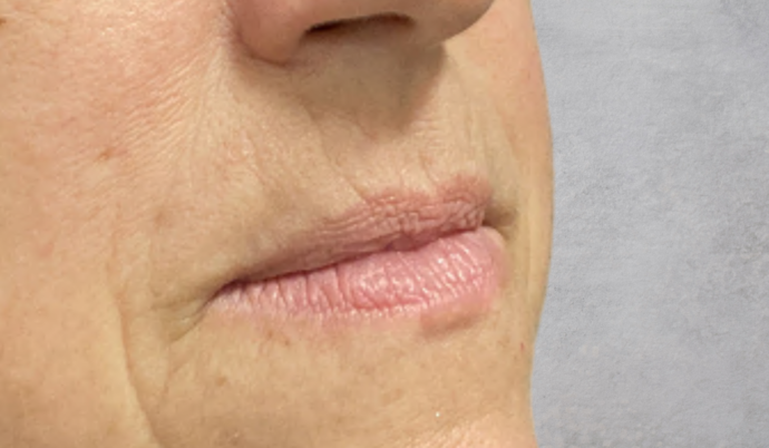 Filler - Lips Case 11 - Before