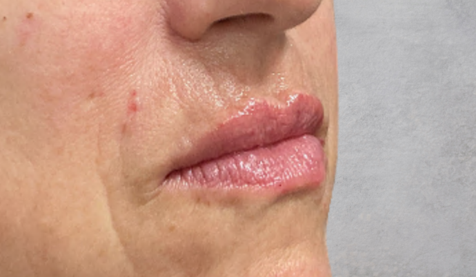 Filler - Lips Case 11 - After