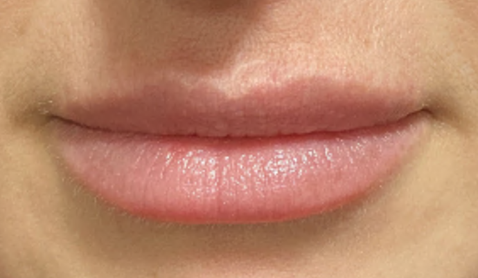 Filler - Lips Case 12 - After