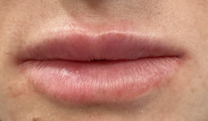 Filler - Lips: Case 13 - After