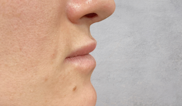 Filler - Lips Case 13 - Before