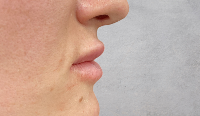 Filler - Lips Case 13 - After