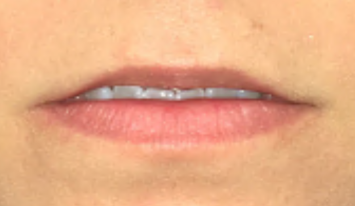 Filler - Lips Case 14 - Before
