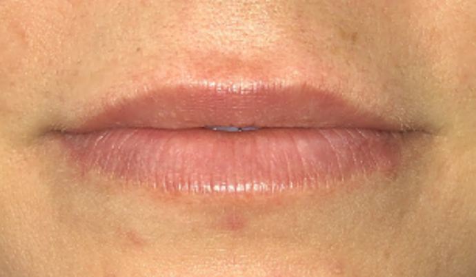 Filler - Lips Case 14 - After