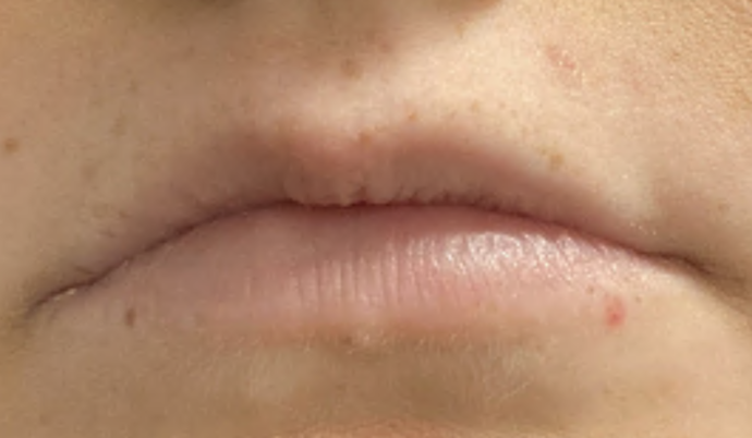 Filler - Lips Case 15 - Before