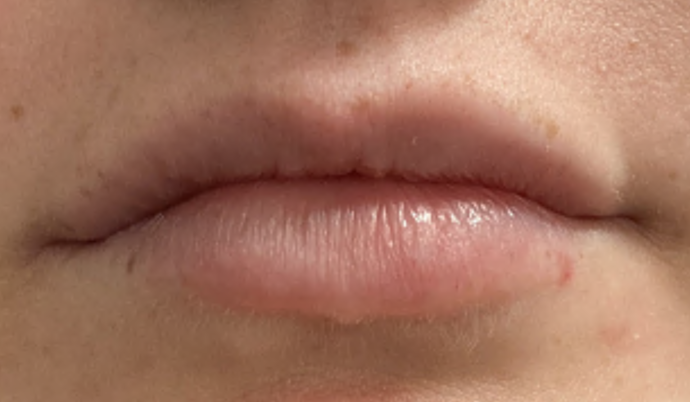 Filler - Lips Case 15 - After