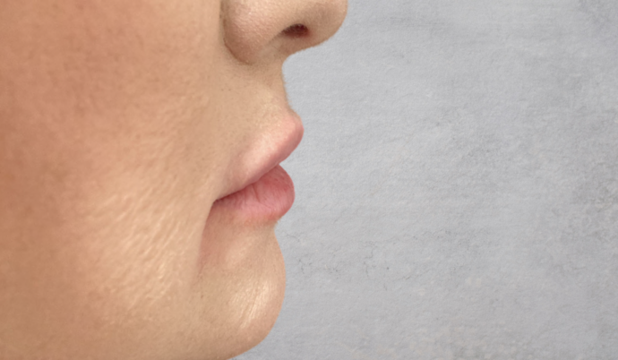 Filler - Lips Case 16 - Before