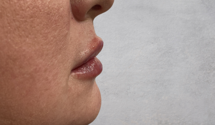 Filler - Lips Case 16 - After