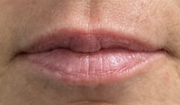 Filler - Lips Case 17 - Before