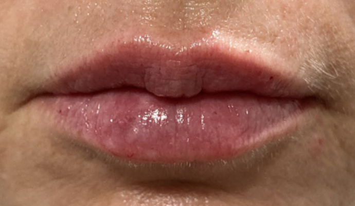 Filler - Lips Case 17 - After