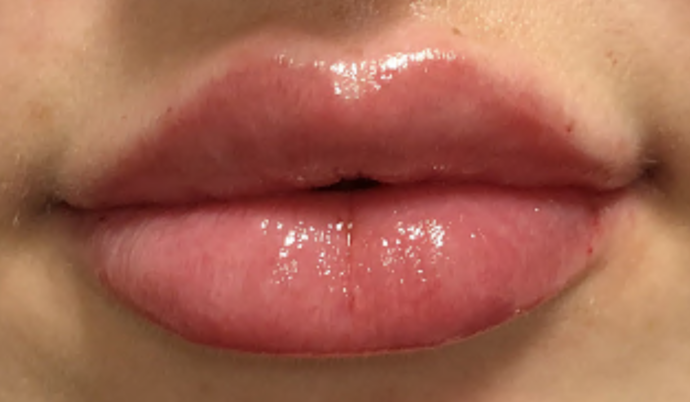 Filler - Lips Case 18 - After