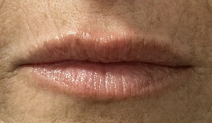 Filler - Lips Case 21 - Before