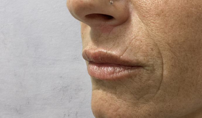 Filler - Lips: Case 21 - Before