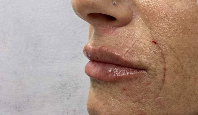 Filler - Lips: Case 21 - After