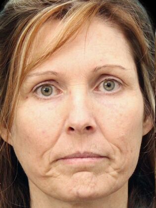 Karen Sticka, PA Case 1 - Before