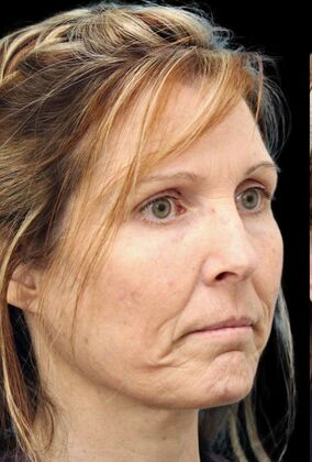 Karen Sticka, PA: Case 1 - Before