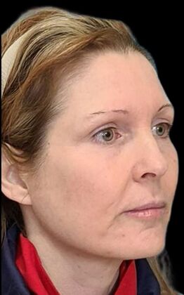 Karen Sticka, PA: Case 1 - After