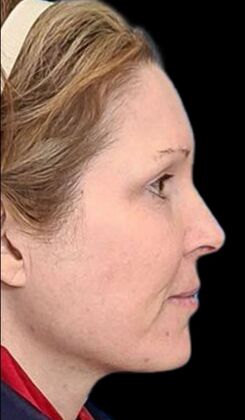 Karen Sticka, PA: Case 1 - After