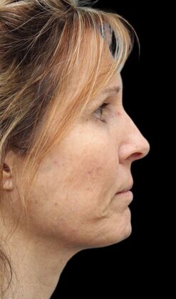 Karen Sticka, PA: Case 1 - Before